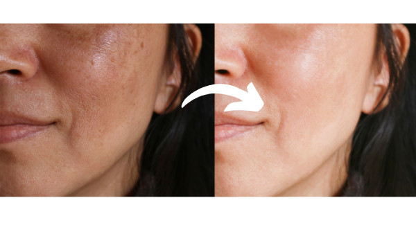 Dermal Repair Complex Reviews Before and After Wrinkles