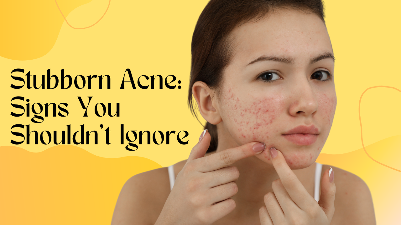 Stubborn Acne Signs