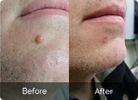 Levinaquin Skin Tag Remover results before and after