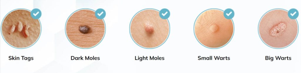 Skin Tags Image